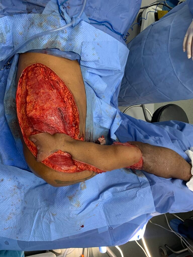 Surgical procedure on exposed leg
