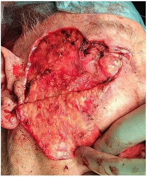 Surgical procedure on human face flap