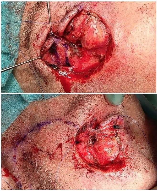 Close-up of surgical procedure on face