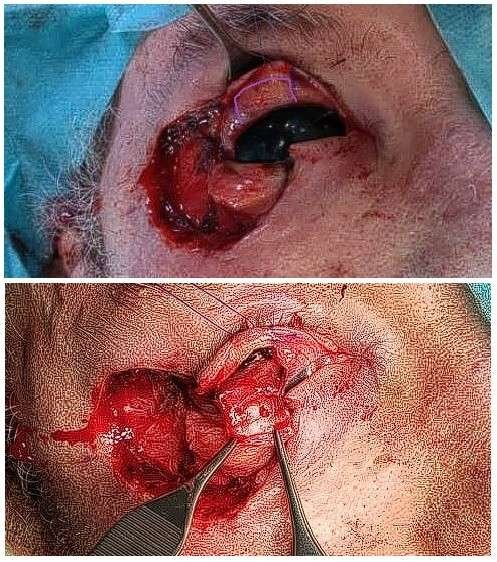 Surgical procedure on human eye