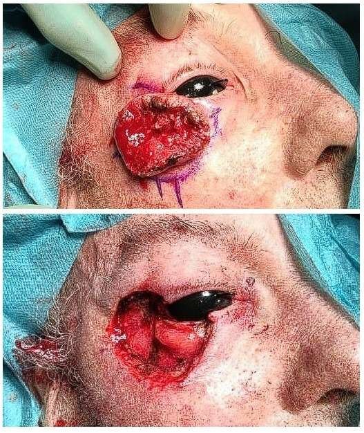 Surgical procedure near the eye