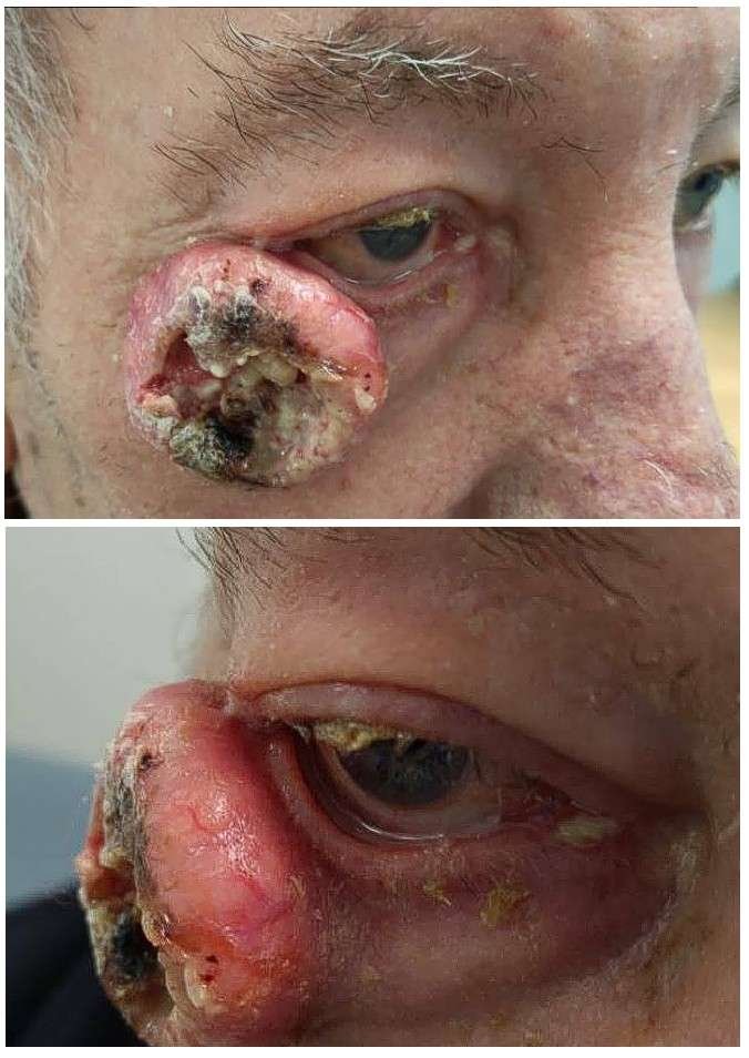 Severe skin condition around the eye