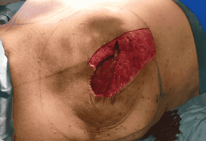 Surgical wound on patient's skin.