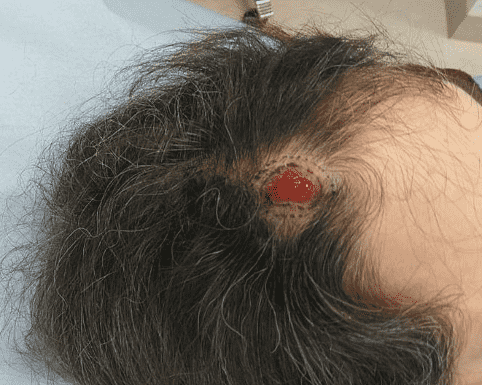 Surgical wound on scalp with stitches