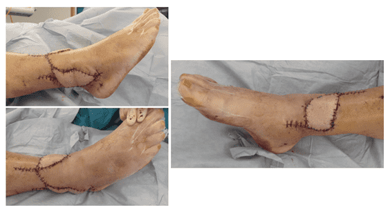 Surgical stitches on foot post-operation