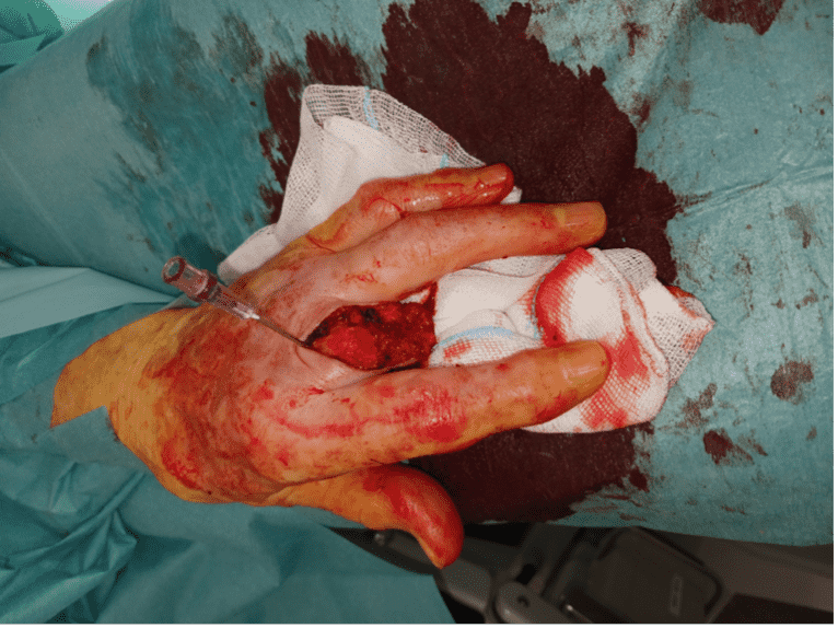 Surgical procedure on injured hand