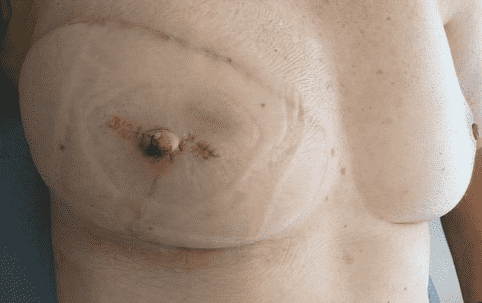 Post-operative breast reconstruction image.