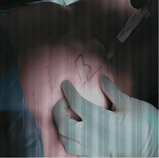 Medical procedure with syringe and marking