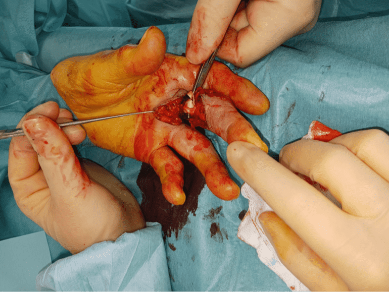Surgical procedure on a hand