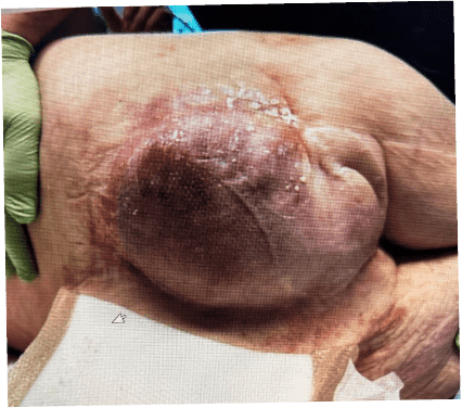 Large swollen area on human skin.