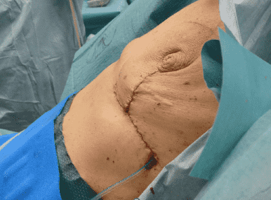 Surgical incision on a patient's abdomen