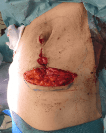 Surgical incision on patient's abdomen