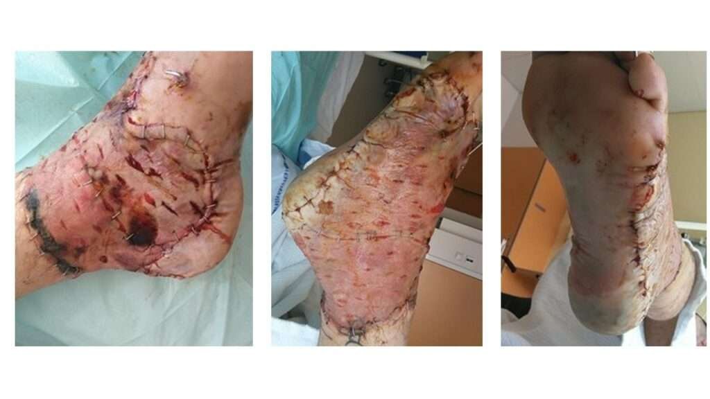 Surgical scars on repaired foot