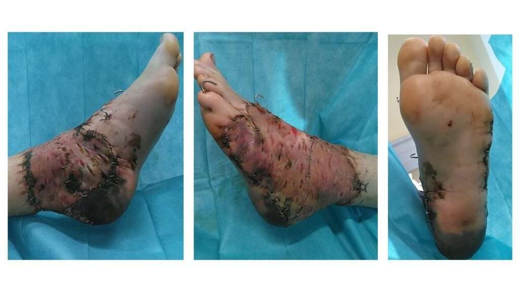 Surgical stitches on a foot after procedure