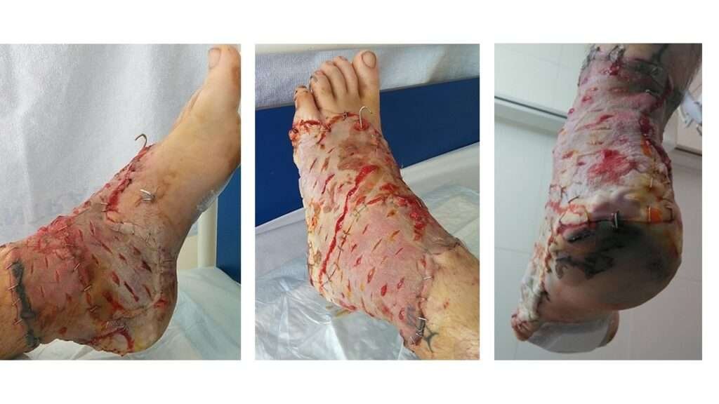 Healing skin graft on foot
