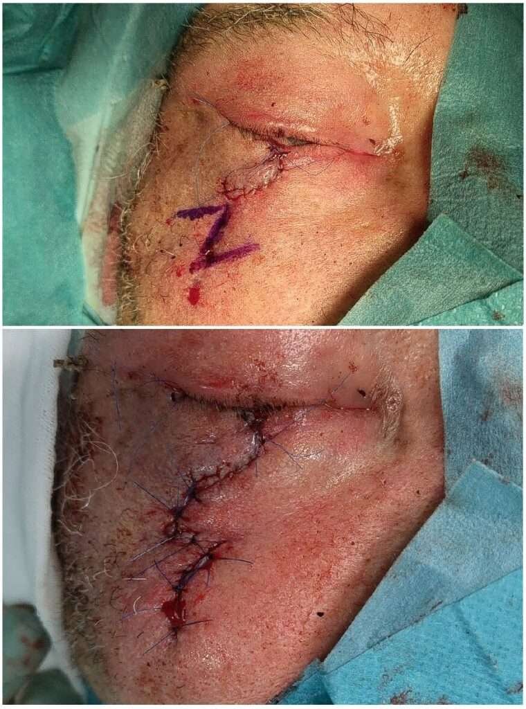 Close-up of facial surgery stitches