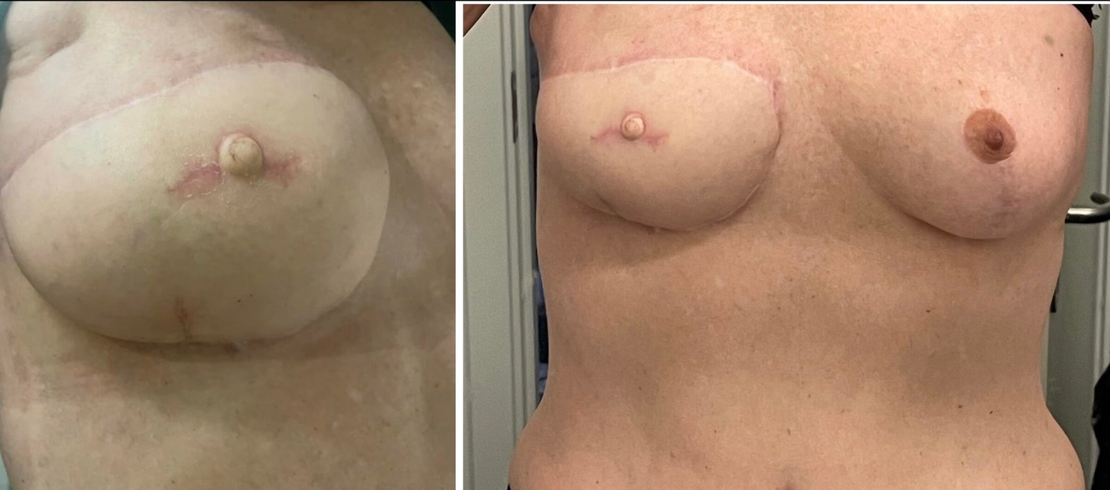 Breast reconstruction surgery results comparison