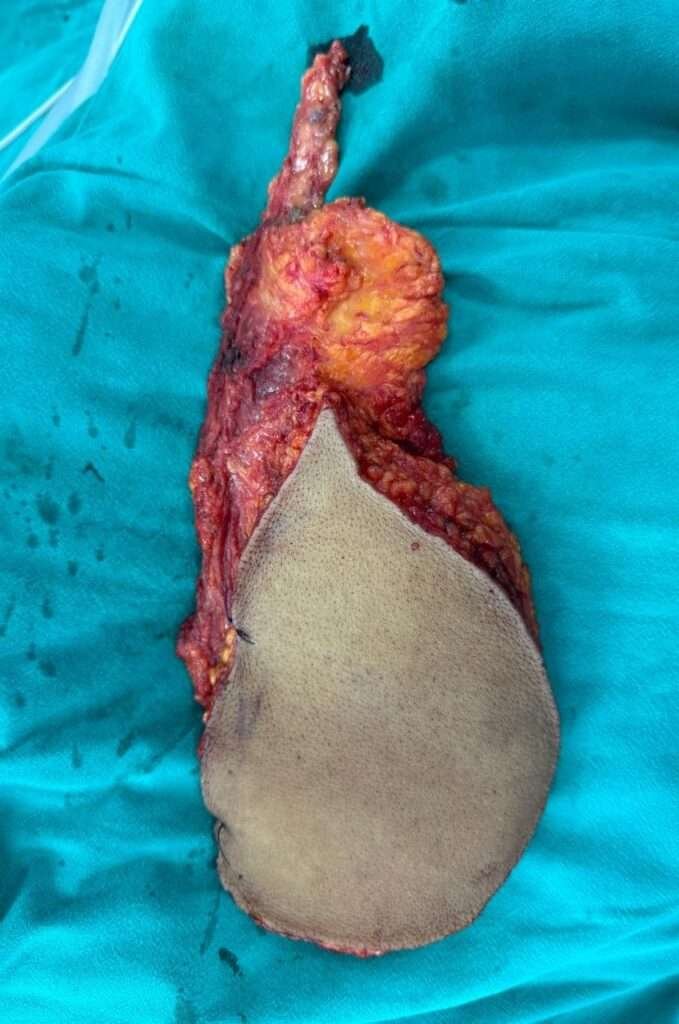 harvested latissimus dorsi 1