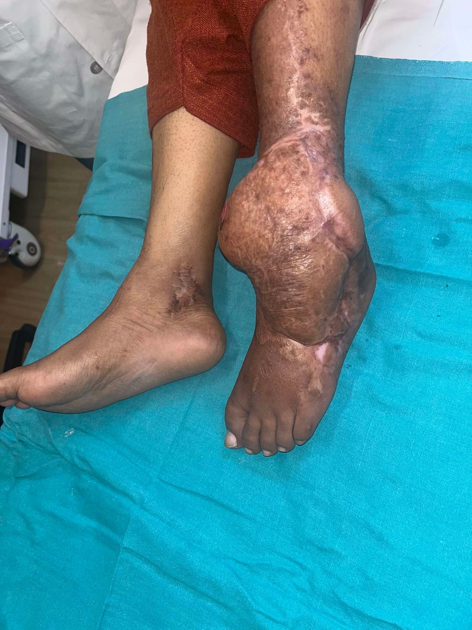 Swollen and scarred foot and ankle