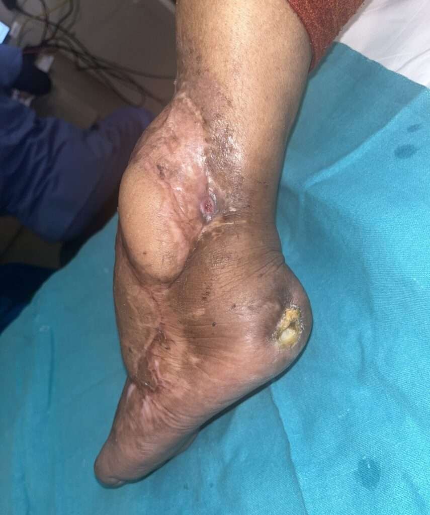 Foot with severe medical condition