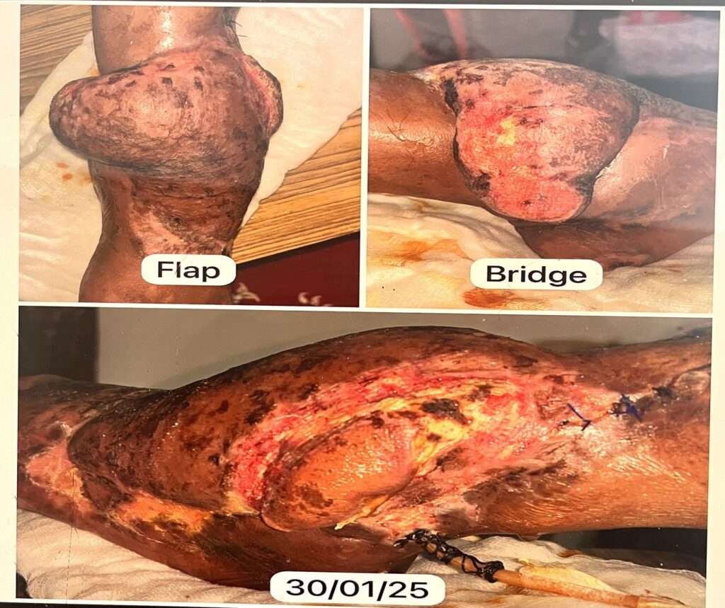 Three images of a bandaged leg wound