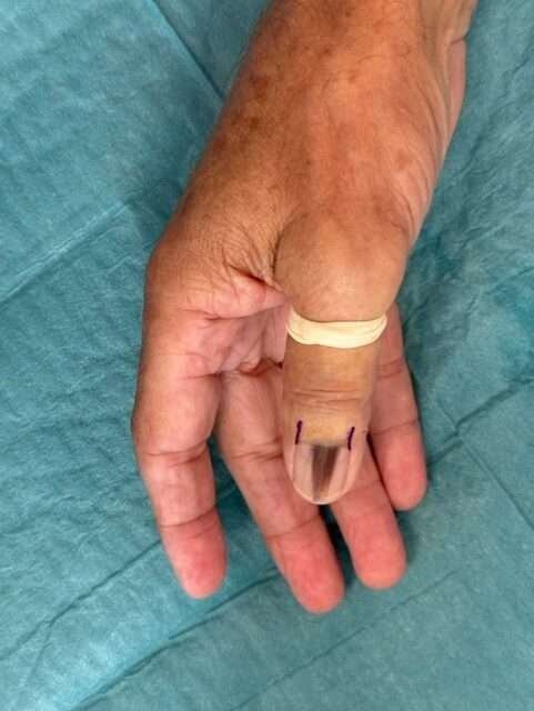 Hand with marked thumbnail and bandage.