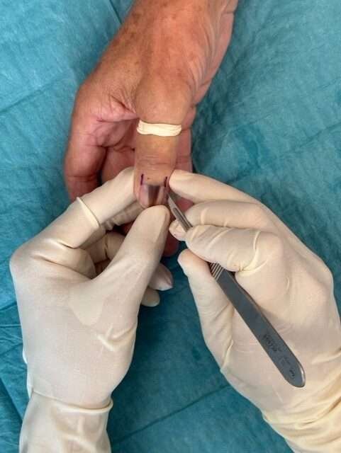 Surgical procedure on a thumb