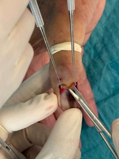 Surgical procedure on a finger
