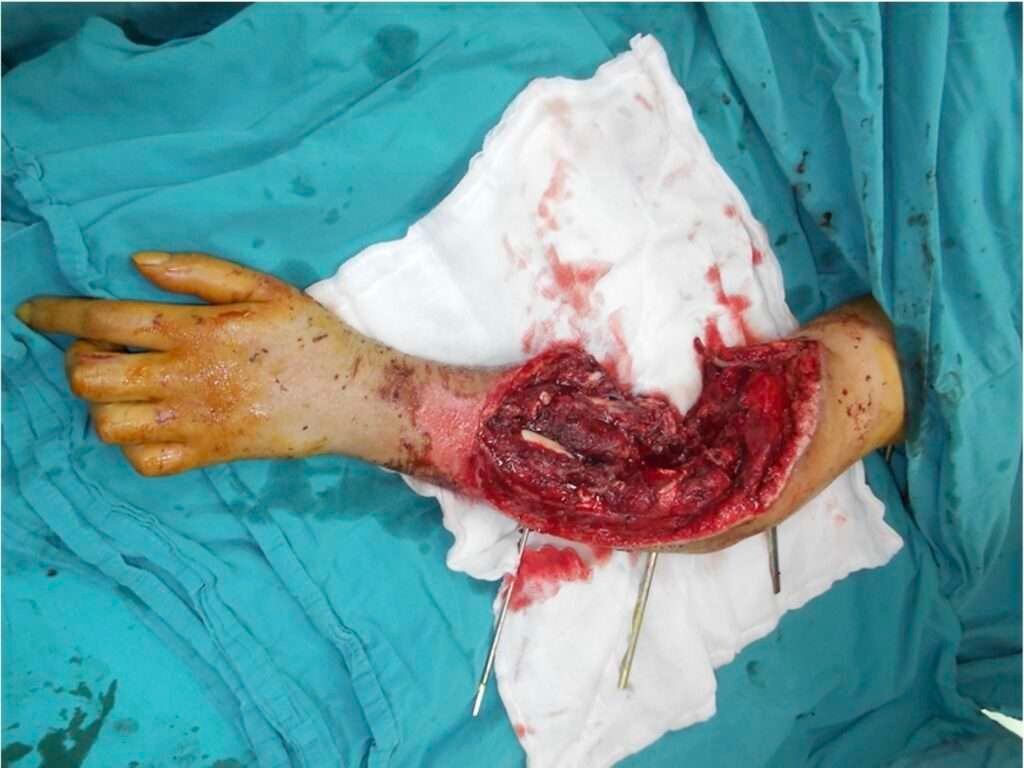 Severely injured forearm with exposed bone.