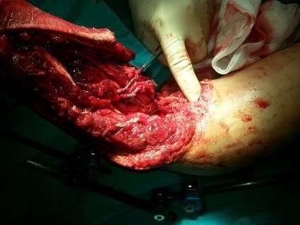 Surgical procedure on a patient's arm.