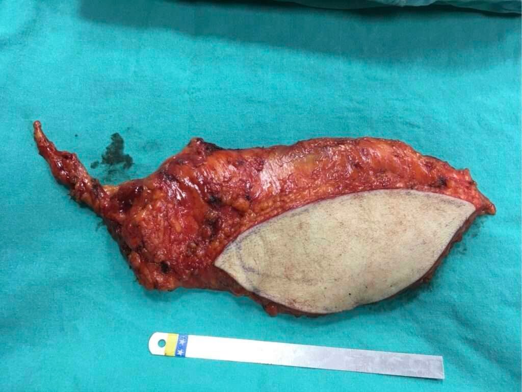 Excised tissue with measuring scale