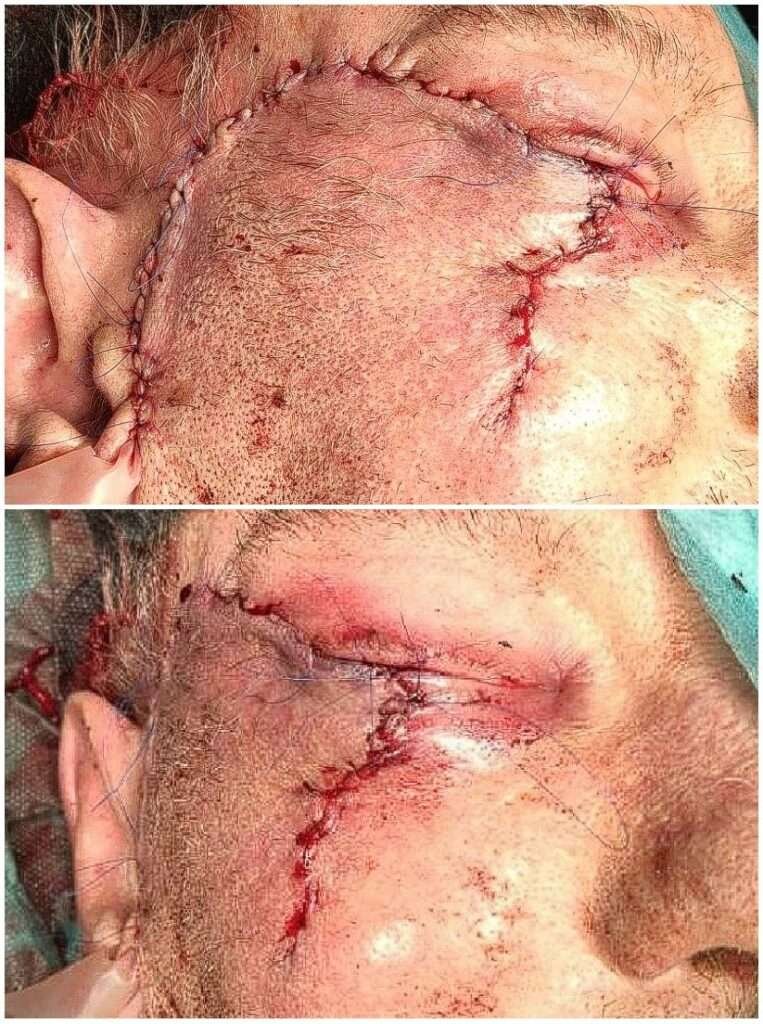 Close-up of facial stitches after surgery