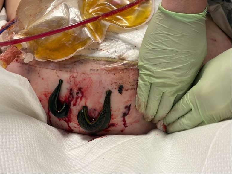 Medical leeches on patient's abdominal wound.