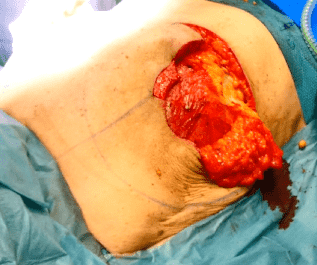 Surgical incision on the abdominal area