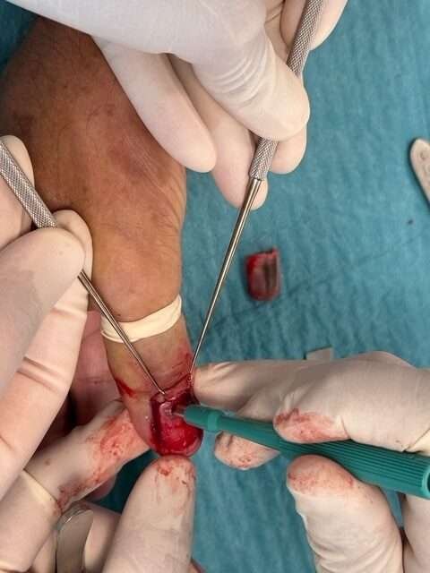 Partial toenail removal surgery procedure.