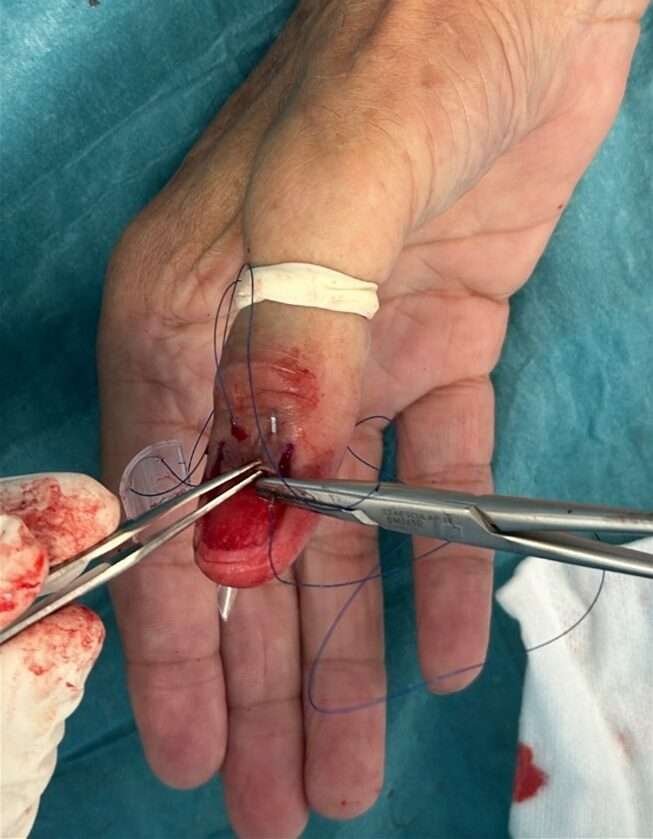 Surgical suturing on injured finger