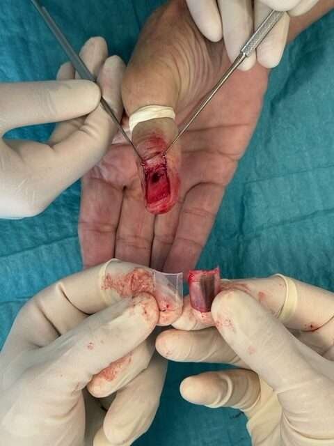 Surgical procedure on a thumb with removed nail