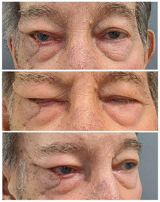 Close-up of eyes with swelling.