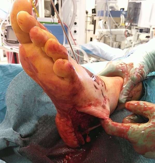 Surgical operation on a patient's foot