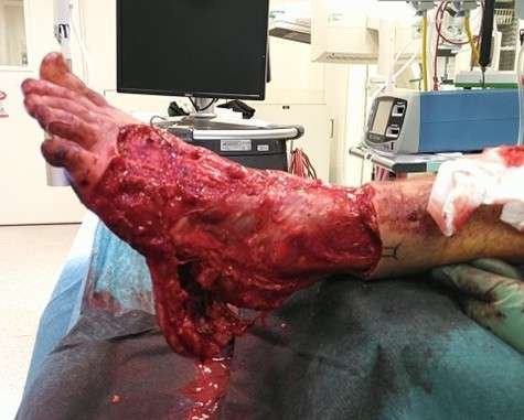 Severely injured foot in medical emergency room