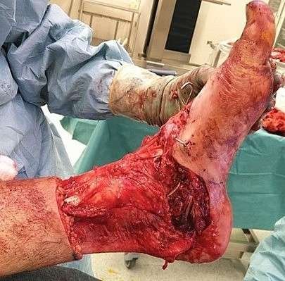 Open foot surgery with exposed tissues.