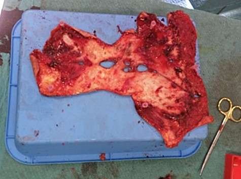 Surgical tissue specimen on a tray.