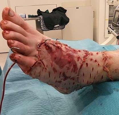 Foot with extensive surgical stitches and wounds