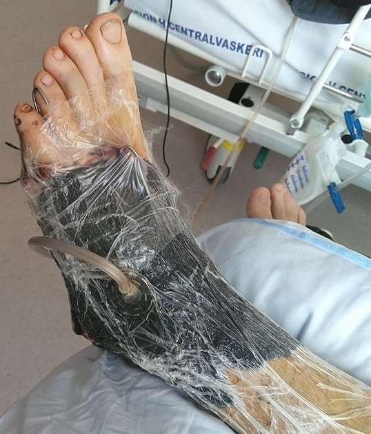 Foot wrapped in plastic with medical device.