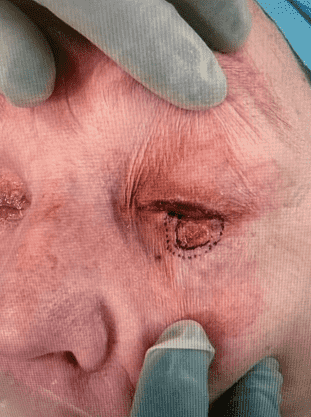 Eye surgery procedure with surgical markings.