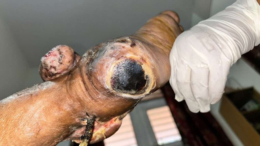 Infected wound on human foot.