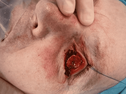 Close-up of surgical eye wound