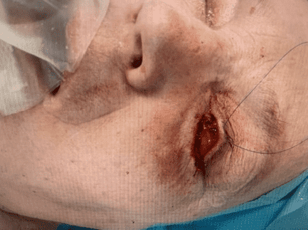Surgical incision near a patient's eye.