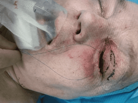 Close-up of face with medical procedure