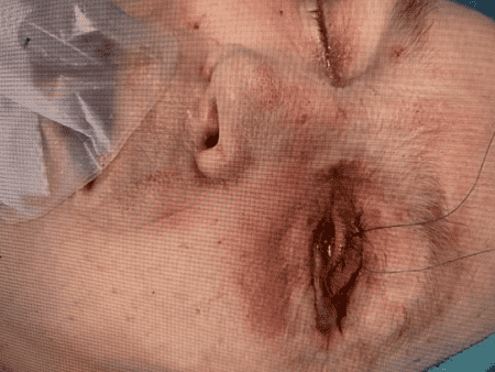 Person with facial injury and a bandage
